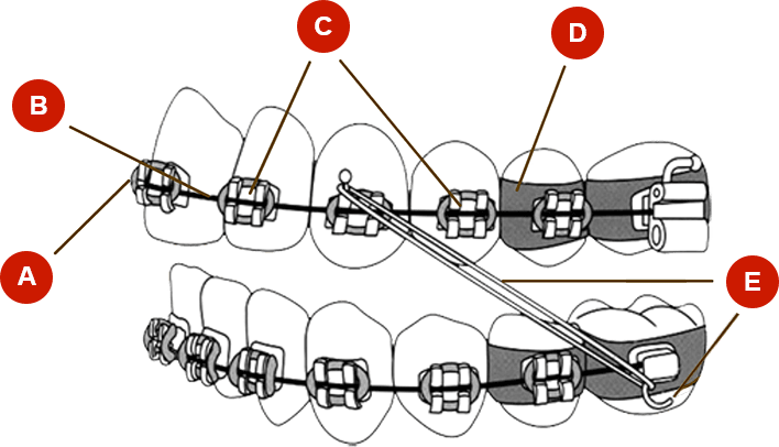 Diagram of braces' components