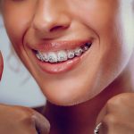 How to Prepare for Braces