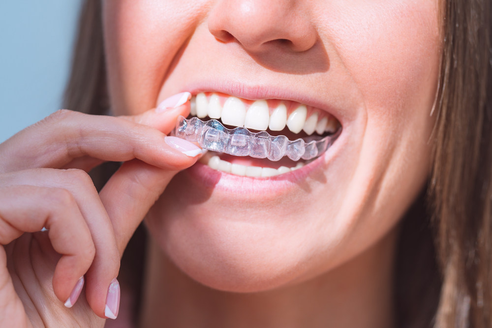 10 Unique Benefits of Invisalign at Crescent Orthodontics in South Lyon, MI